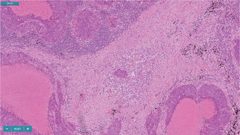 Metastasis Without Heatmap